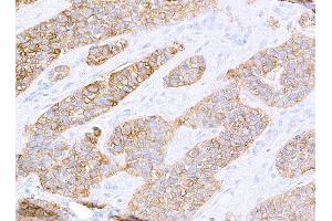 Immunohistochemistry (IHC) image for anti-Receptor tyrosine-protein kinase erbB-2 (ErbB2/Her2) (AA 1205-1255) antibody (ABIN7455181) (Recombinant ErbB2/Her2 抗体  (AA 1205-1255))