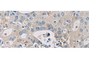 Immunohistochemistry of paraffin-embedded Human breast cancer tissue using WFDC3 Polyclonal Antibody at dilution of 1:40(x200) (WFDC3 抗体)