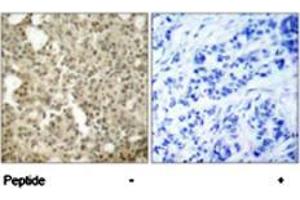 Immunohistochemical analysis of paraffin-embedded human breast carcinoma tissue using PRKCD polyclonal antibody  . (PKC delta 抗体)