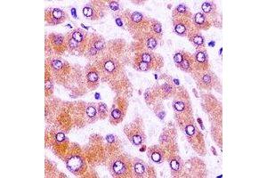 Immunohistochemical analysis of MBTPS1 staining in human liver cancer formalin fixed paraffin embedded tissue section. (MBTPS1 抗体)