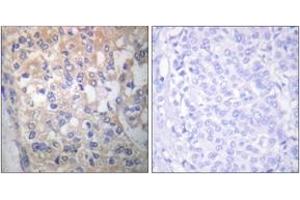 Immunohistochemistry analysis of paraffin-embedded human breast carcinoma, using Fyn (Phospho-Tyr530) Antibody. (FYN 抗体  (pTyr531))