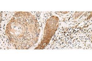 Immunohistochemistry of paraffin-embedded Human esophagus cancer tissue using EXD2 Polyclonal Antibody at dilution of 1:55(x200) (EXD2 抗体)