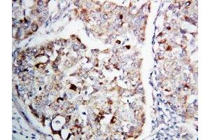IHC-P: MEK1 antibody testing of human lung cancer tissue (MEK1 抗体  (C-Term))