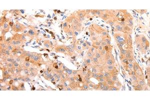 Immunohistochemistry of paraffin-embedded Human lung cancer tissue using CELSR2 Polyclonal Antibody at dilution 1:50 (CELSR2 抗体)