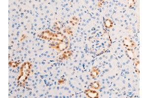 Immunohistochemistry (IHC) image for anti-Receptor tyrosine-protein kinase erbB-2 (ErbB2/Her2) (pTyr1248) antibody (ABIN6256630)
