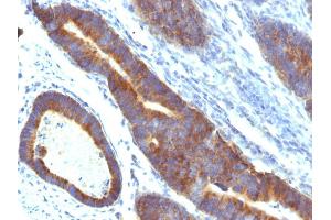 Formalin-fixed, paraffin-embedded human Colon Carcinoma stained with MUC3 Monoclonal Antibody (MUC3/1154). (MUC3A 抗体)
