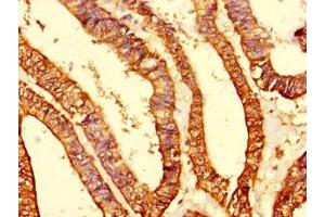 Immunohistochemistry of paraffin-embedded human endometrial cancer using ABIN7142242 at dilution of 1:100 (Putative Mitochondrial Ribosomal Protein S1 (MRPS1) (AA 1-201) 抗体)