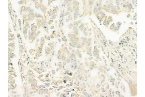 ABIN6261918 and ABIN6278469 at 1/100 staining human lung squamous cell carcinoma by IHC-P. (GUCY1B2 抗体)
