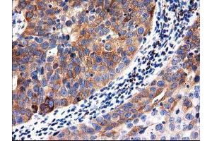 Immunohistochemical staining of paraffin-embedded Carcinoma of Human kidney tissue using anti-ALDH1L1 mouse monoclonal antibody. (ALDH1L1 抗体)