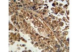 ABCG1 antibody immunohistochemistry analysis in formalin fixed and paraffin embedded human lung carcinoma.