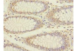 Immunohistochemistry of paraffin-embedded human colon cancer using ABIN7151990 at dilution of 1:100 (ERBB2IP 抗体  (AA 1193-1412))