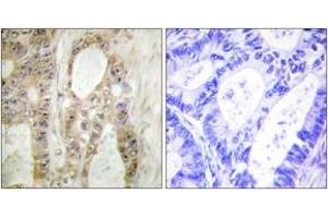 Immunohistochemistry analysis of paraffin-embedded human colon carcinoma, using Chk1 (Ab-296) Antibody. (CHEK1 抗体  (AA 266-315))