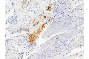 ABIN6256149 and ABIN6267294 at 1/100 staining human lung squamous cell carcinoma by IHC-P.