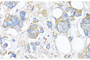 Immunohistochemistry of paraffin-embedded Human breast cancer using TIMP2 Polyclonal Antibody at dilution of 1:150 (40x lens). (TIMP2 抗体)