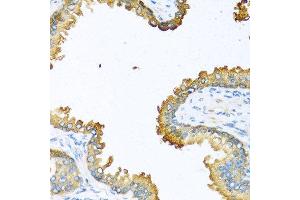 Immunohistochemistry of paraffin-embedded human prostate using VEGFC antibody at dilution of 1:100 (40x lens). (VEGFC 抗体)