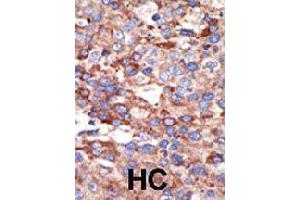 Formalin-fixed and paraffin-embedded human hepatocellular carcinoma tissue reacted with YY1 polyclonal antibody  , which was peroxidase-conjugated to the secondary antibody, followed by DAB staining .