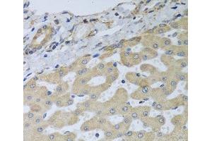 Immunohistochemistry of paraffin-embedded Human liver damage using ATAD3B Polyclonal Antibody at dilution of 1:100 (40x lens).