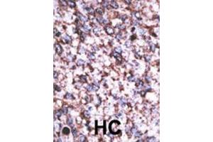 Formalin-fixed and paraffin-embedded human cancer tissue reacted with the primary antibody, which was peroxidase-conjugated to the secondary antibody, followed by AEC staining. (BACE2C 抗体  (C-Term))