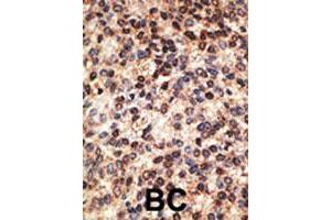 Formalin-fixed and paraffin-embedded human breast cancer tissue reacted with JAG2 polyclonal antibody  , which was peroxidase-conjugated to the secondary antibody, followed by DAB staining. (JAG2 抗体  (C-Term))