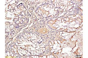 Formalin-fixed and paraffin embedded human rectal carcinoma labeled with Rabbit Anti TIMP-1 Polyclonal Antibody, Unconjugated (ABIN707441) at 1:200 followed by conjugation to the secondary antibody and DAB staining (TIMP1 抗体  (AA 131-207))