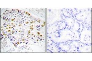 Immunohistochemistry analysis of paraffin-embedded human lung carcinoma tissue, using Retinoblastoma (Ab-249) Antibody.