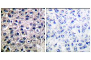 Immunohistochemical analysis of paraffin-embedded human breast carcinoma tissue using MMP-14 antibody (ABIN5976458). (MMP14 抗体  (C-Term))