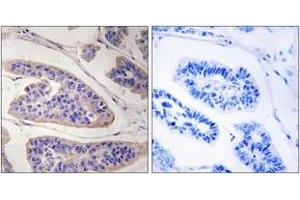 Immunohistochemistry analysis of paraffin-embedded human breast carcinoma tissue, using ENAH Antibody. (ENAH 抗体  (AA 472-521))