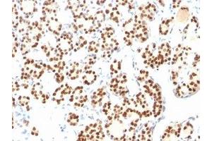 Formalin-fixed, paraffin-embedded human thyroid stained with TTF1 antibody (8G7G3/1 + NX2. (TTF1 抗体)