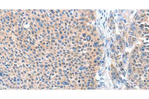 Immunohistochemistry of paraffin-embedded Human liver cancer tissue using ADAM20 Polyclonal Antibody at dilution 1:50 (ADAM20 抗体)