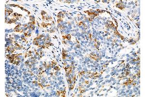 ABIN6264014 and ABIN6276720 at 1/100 staining Human ovarian cancer by IHC-P. (Phenylalanine Hydroxylase 抗体  (N-Term))
