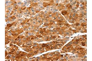 The image on the left is immunohistochemistry of paraffin-embedded Human liver cancer tissue using ABIN7128947(CIDEC Antibody) at dilution 1/50, on the right is treated with fusion protein.