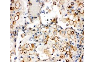 IHC-P: Integrin alpha 1 antibody testing of human lung cancer tissue