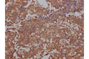 IHC image of ABIN7127851 diluted at 1:100 and staining in paraffin-embedded human lung cancer performed on a Leica BondTM system. (Recombinant Topoisomerase II alpha 抗体)