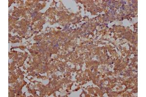 IHC image of ABIN7127851 diluted at 1:100 and staining in paraffin-embedded human lung cancer performed on a Leica BondTM system.