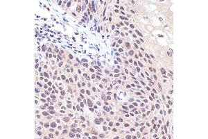Immunohistochemistry of paraffin-embedded human esophageal cancer using Transportin 3 (Transportin 3 (TNPO3)) Rabbit mAb (ABIN7270971) at dilution of 1:100 (40x lens). (Transportin 3 抗体)