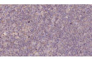 ABIN6273144 at 1/100 staining Human lymph cancer tissue by IHC-P. (NDUFB11 抗体  (N-Term))