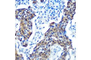 Immunohistochemistry of paraffin-embedded human cervix cancer using [KO Validated] CDKN2A/p16INK4a Rabbit mAb (ABIN6131541, ABIN6139280, ABIN6139282 and ABIN7101380) at dilution of 1:100 (40x lens). (CDKN2A 抗体)