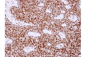 IHC-P Image Immunohistochemical analysis of paraffin-embedded human lung cancer, using APE1, antibody at 1:250 dilution. (APEX1 抗体  (Center))