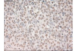 Immunohistochemical staining of paraffin-embedded Adenocarcinoma of breast tissue using anti-SOX17 mouse monoclonal antibody. (SOX17 抗体  (AA 177-414))