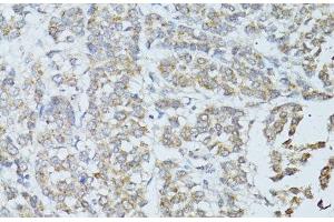 Immunohistochemistry of paraffin-embedded Human colon carcinoma using TEFM Polyclonal Antibody at dilution of 1:100 (40x lens).