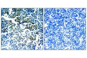 Immunohistochemical analysis of paraffin-embedded human tonsil tumor tissue using Bcr(Phospho-Tyr177) Antibody(left) or the same antibody preincubated with blocking peptide(right). (BCR 抗体  (pTyr177))