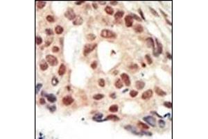 Formalin-fixed and paraffin-embedded human cancer tissue reacted with the primary antibody, which was peroxidase-conjugated to the secondary antibody, followed by AEC staining. (PRKG2 抗体  (C-Term))