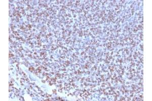 IHC testing of FFPE Ewings sarcoma with recombinant NKX2. (Nkx2-2 抗体  (AA 1-119))