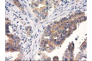 Immunohistochemical staining of paraffin-embedded Adenocarcinoma of Human colon tissue using anti-RTN4IP1 mouse monoclonal antibody. (RTN4IP1 抗体)