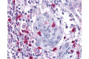 Anti-Leukotriene B4 Receptor / BLT1 antibody IHC of human Pancreas, Carcinoma and Leukocytes. (Leukotriene B4 Receptor/BLT 抗体  (Cytoplasmic Domain))