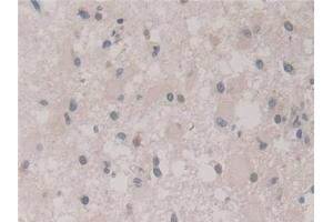 Detection of FIS1 in Human Glioma Tissue using Polyclonal Antibody to Fission 1 (FIS1) (Fission 1 抗体  (AA 1-117))
