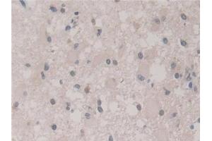 Detection of FIS1 in Human Glioma Tissue using Polyclonal Antibody to Fission 1 (FIS1)