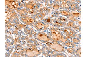 The image on the left is immunohistochemistry of paraffin-embedded Human thyroid cancer tissue using ABIN7128172(ACOX2 Antibody) at dilution 1/20, on the right is treated with fusion protein. (Acox2 抗体)