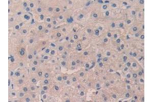 Detection of DHH in Human Liver cancer Tissue using Polyclonal Antibody to Hedgehog Homolog, Desert (DHH) (desert Hedgehog 抗体  (AA 241-383))