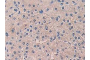 Detection of DHH in Human Liver cancer Tissue using Polyclonal Antibody to Hedgehog Homolog, Desert (DHH)